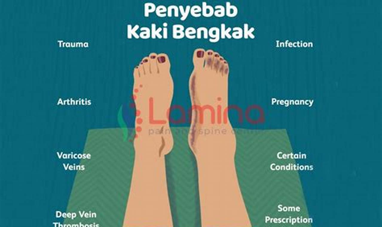 Cara Mengatasi Kaki Bengkak